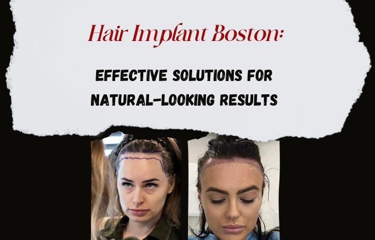 Hair-Implant-Boston-Effective-Solutions-for-Natural-Looking-Results