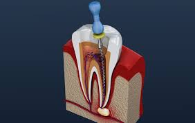 Root Canal Treatment